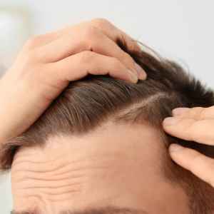 Hair Restoration Needs