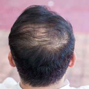 Hair Thinning