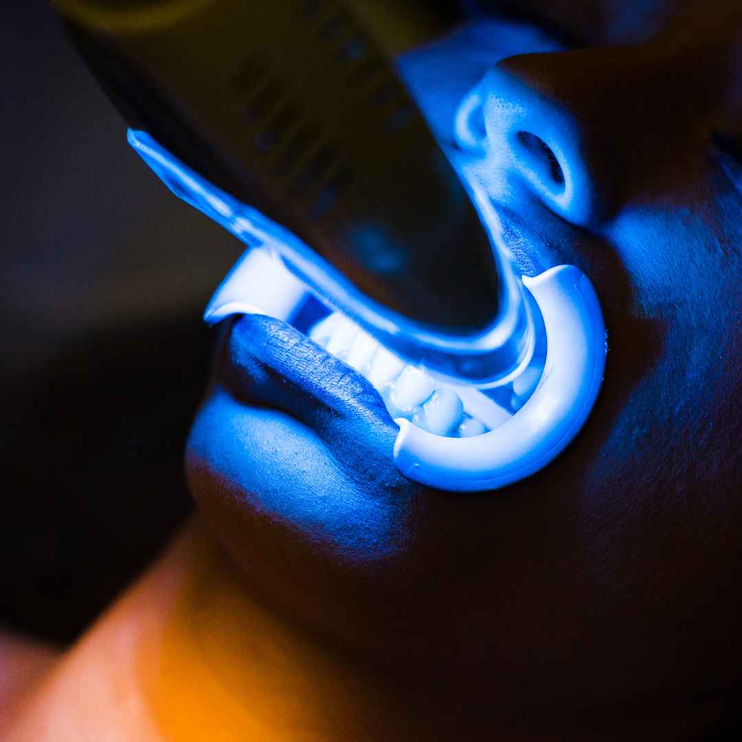 LED Light-Accelerated Whitening