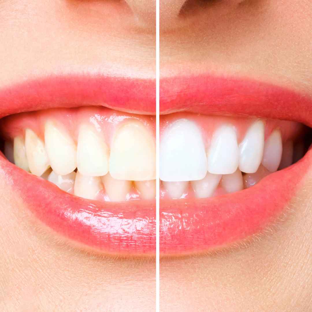 Laser teeth whitening