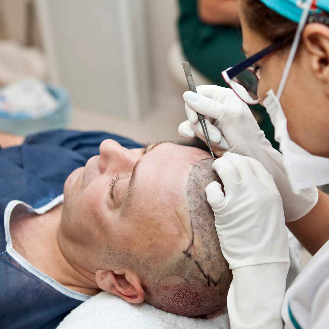 Minimal Hair Transplant Downtime