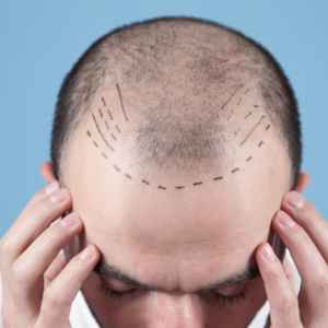 Minimal Scarring from Hair Transplant