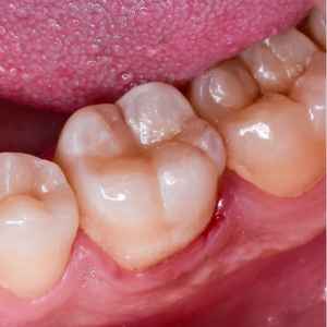 Porcelain Tooth Filling