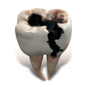 Tooth Extraction in Thane (2024) 11 Severe Decay or Infection