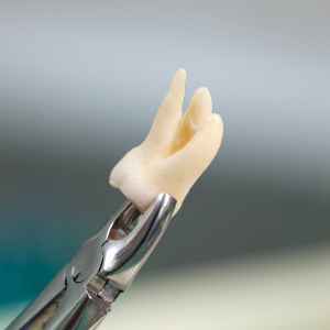 Tooth Extraction in Thane (2024) 2 Simple Tooth Extractions