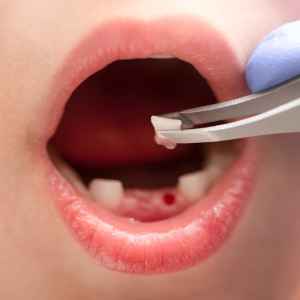 Tooth Extraction in Thane (2024) 7 Tooth Extraction