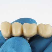 Best Family Dentist in Rabodi, Thane 7 Dental Bridges