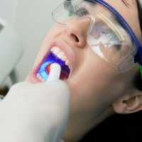 Best Family Dentist in Rabodi, Thane 5 Dental Filling