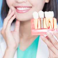 Best Family Dentist in Rabodi, Thane 8 Dental Implants