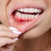 Best Family Dentist in Rabodi, Thane 13 Gum Disease