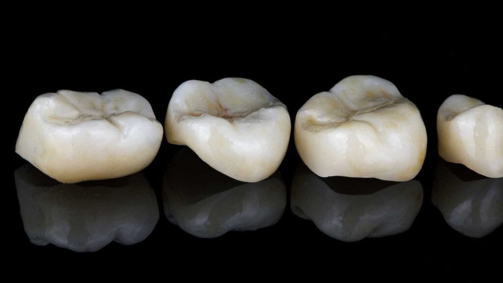 Types of Dental Crowns