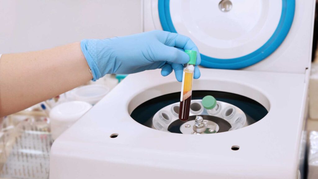 3 Why Choose Elite Dermadent for PRP Hair Treatment in Thane