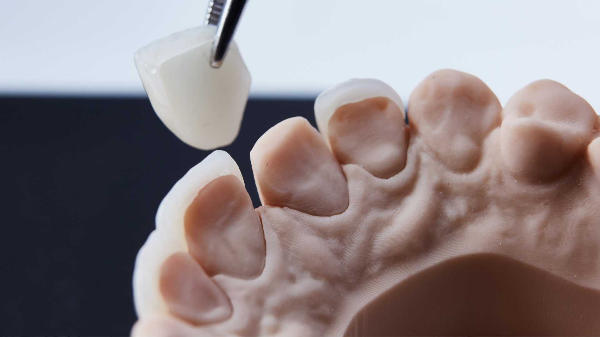 Dental Crown in Thane