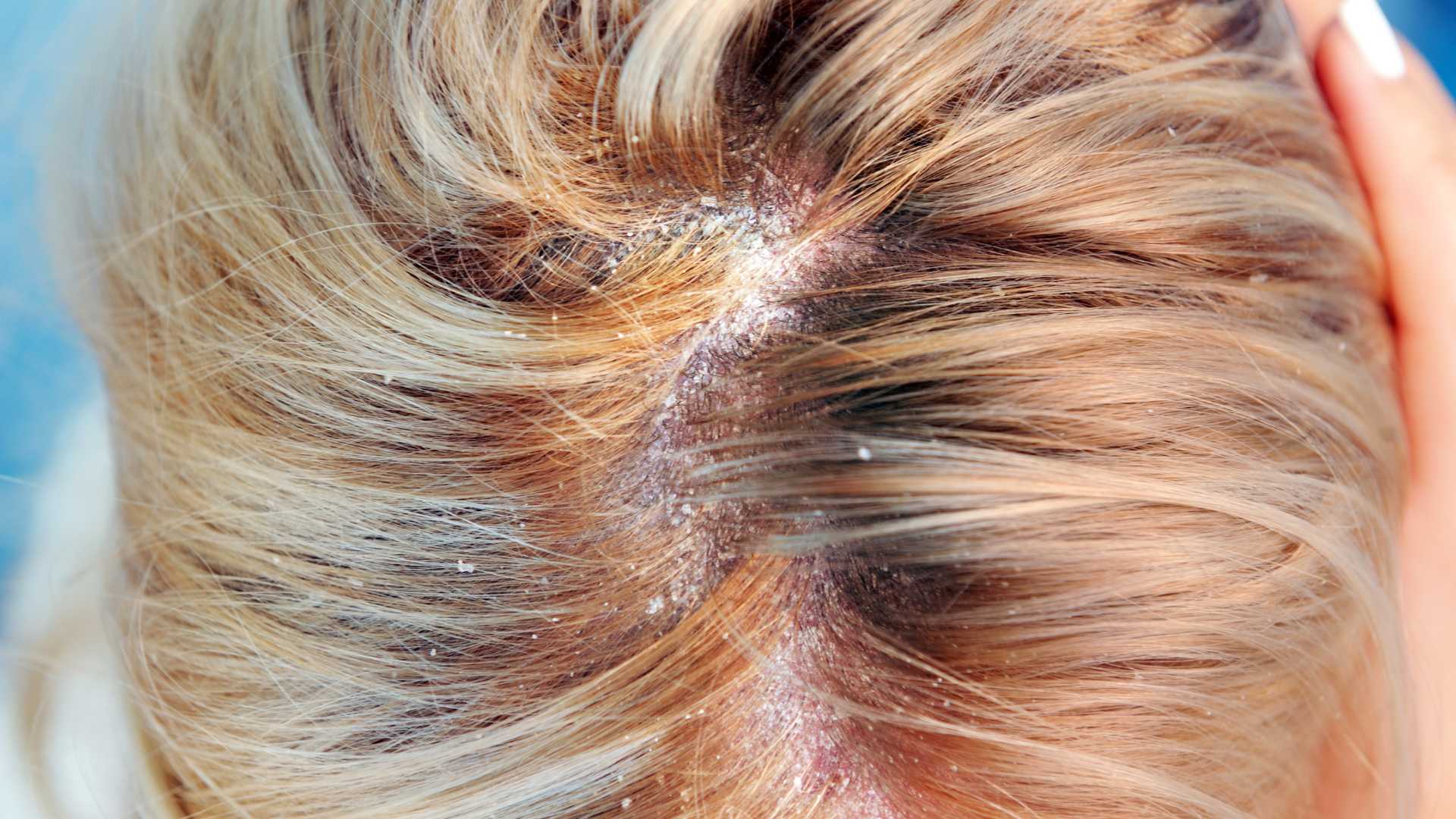 Seborrheic Dermatitis (Dandruff) Treatment in Thane