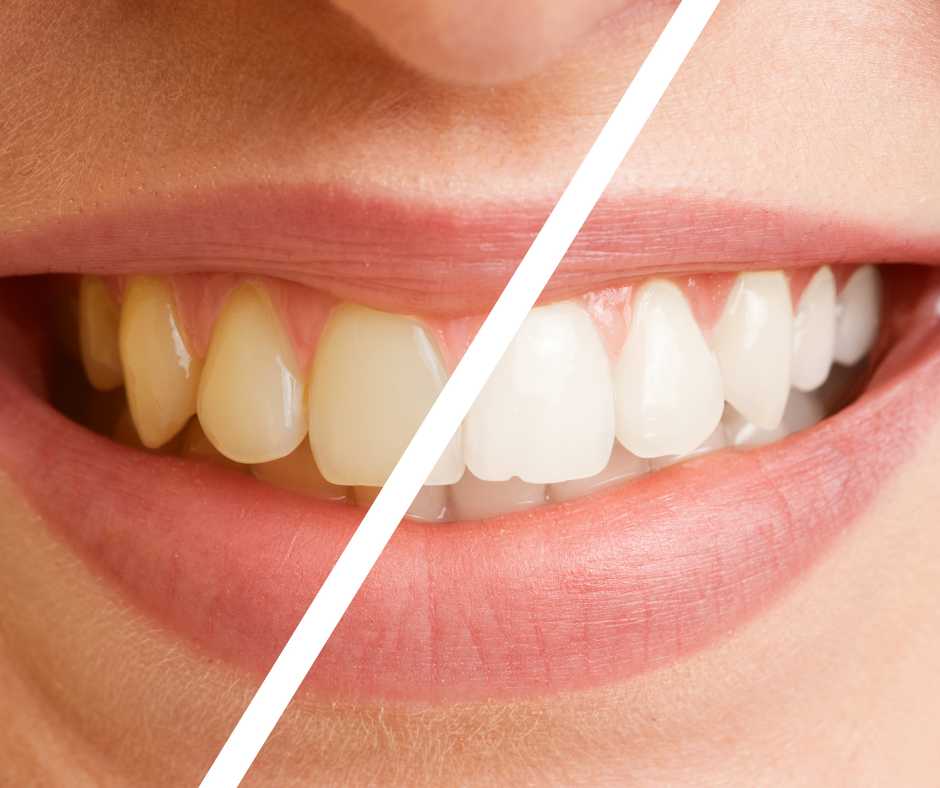 Teeth Cleaning and Polishing in Thane (2024) 1 Teeh Cleaning and Polishing in Thane