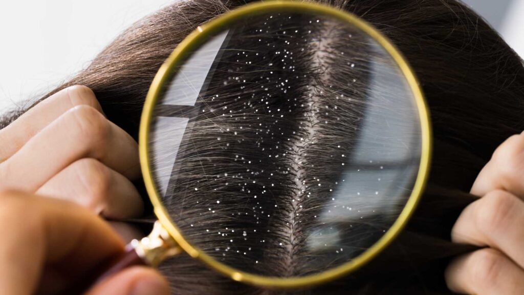 Understanding Seborrheic Dermatitis