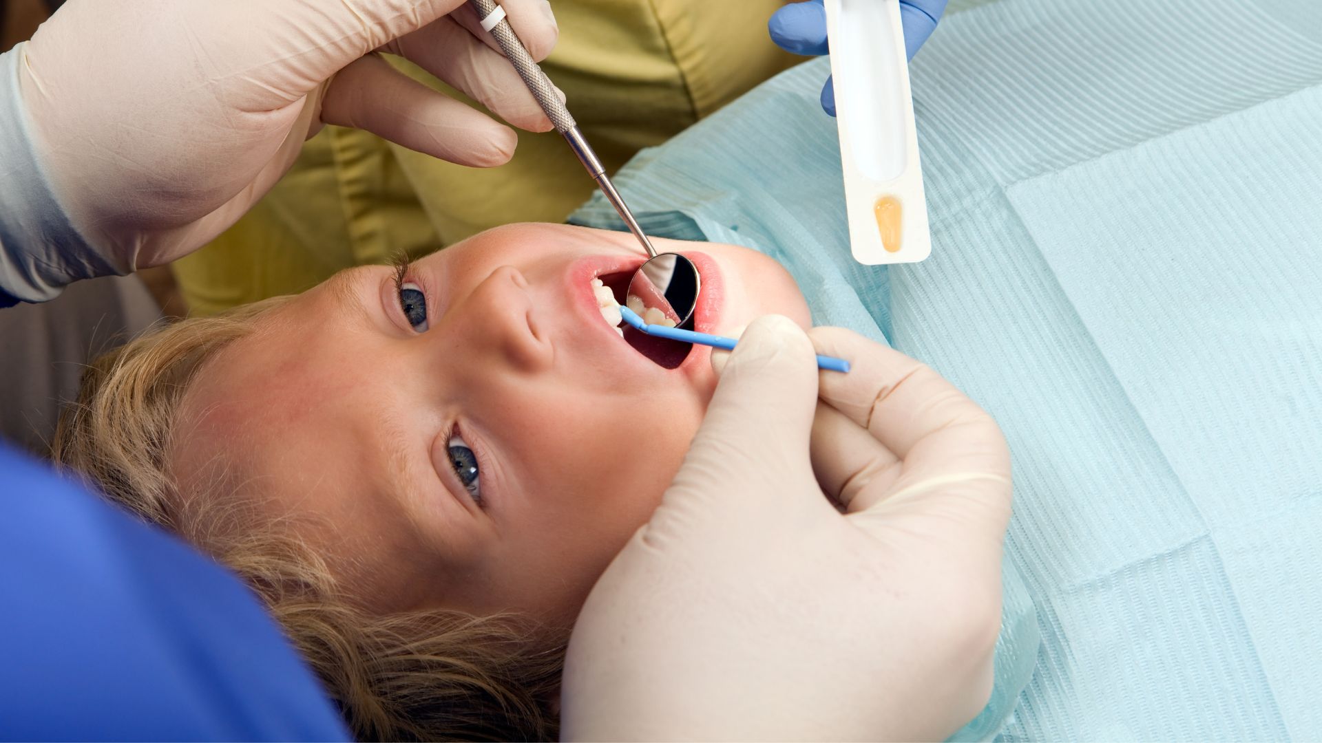 Fluoride Therapy for Kids in Thane (2024) 1 Fluoride Therapy for Kids in Thane