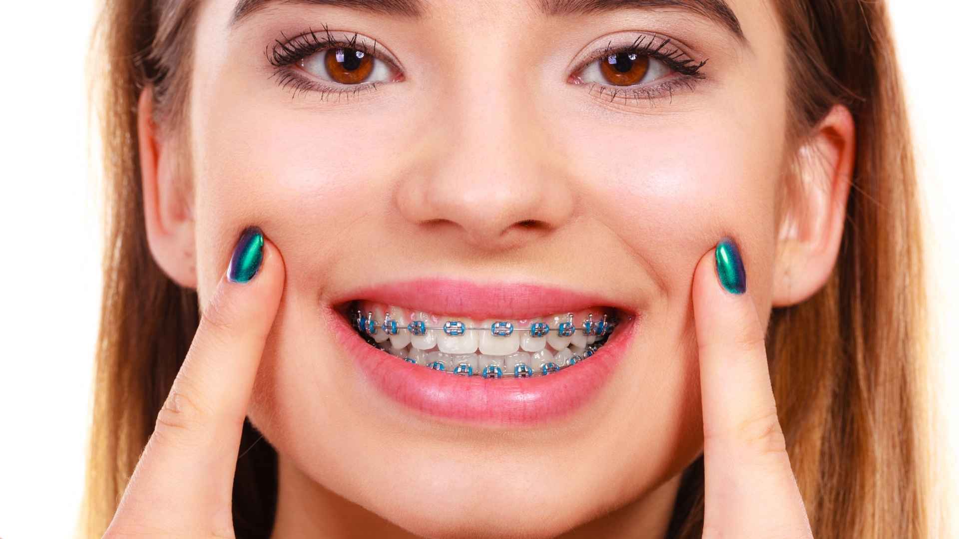 Metal Braces in Thane