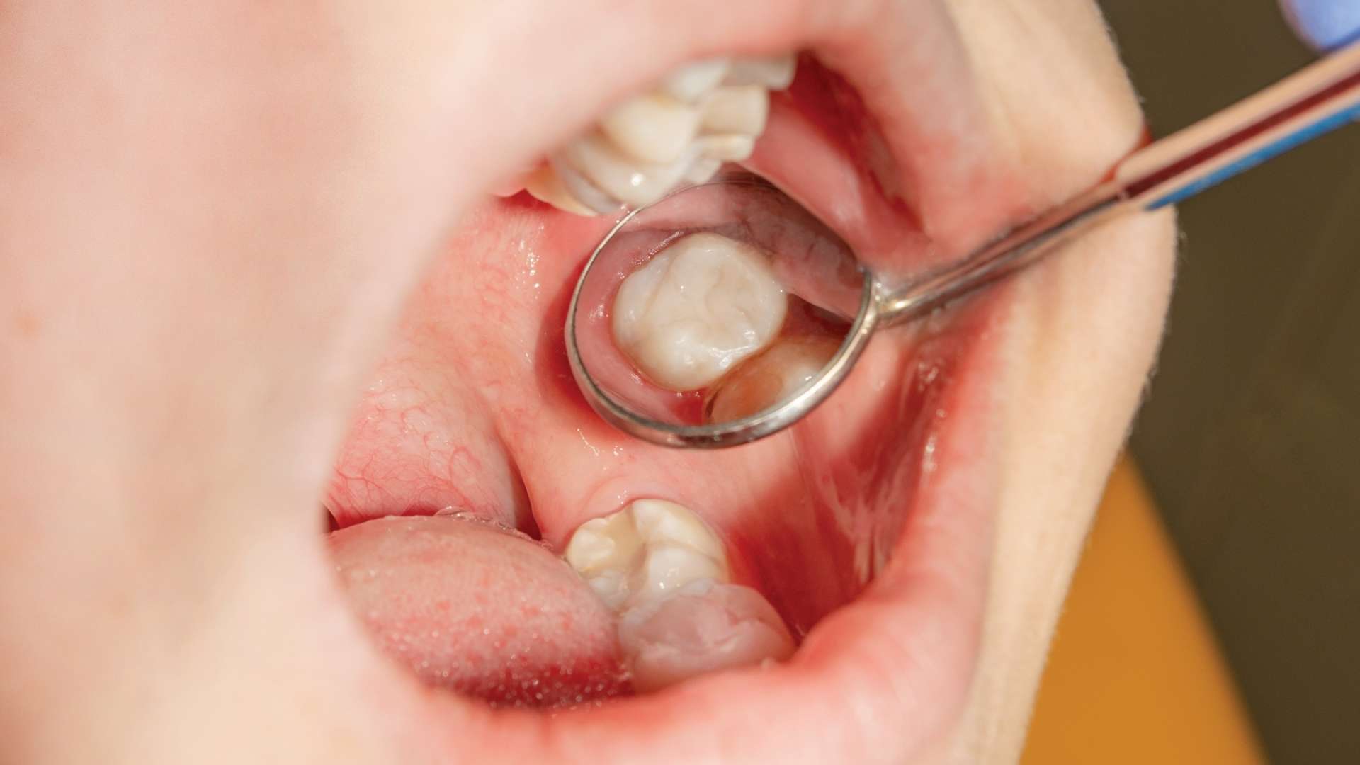 Tooth Restoration in Thane