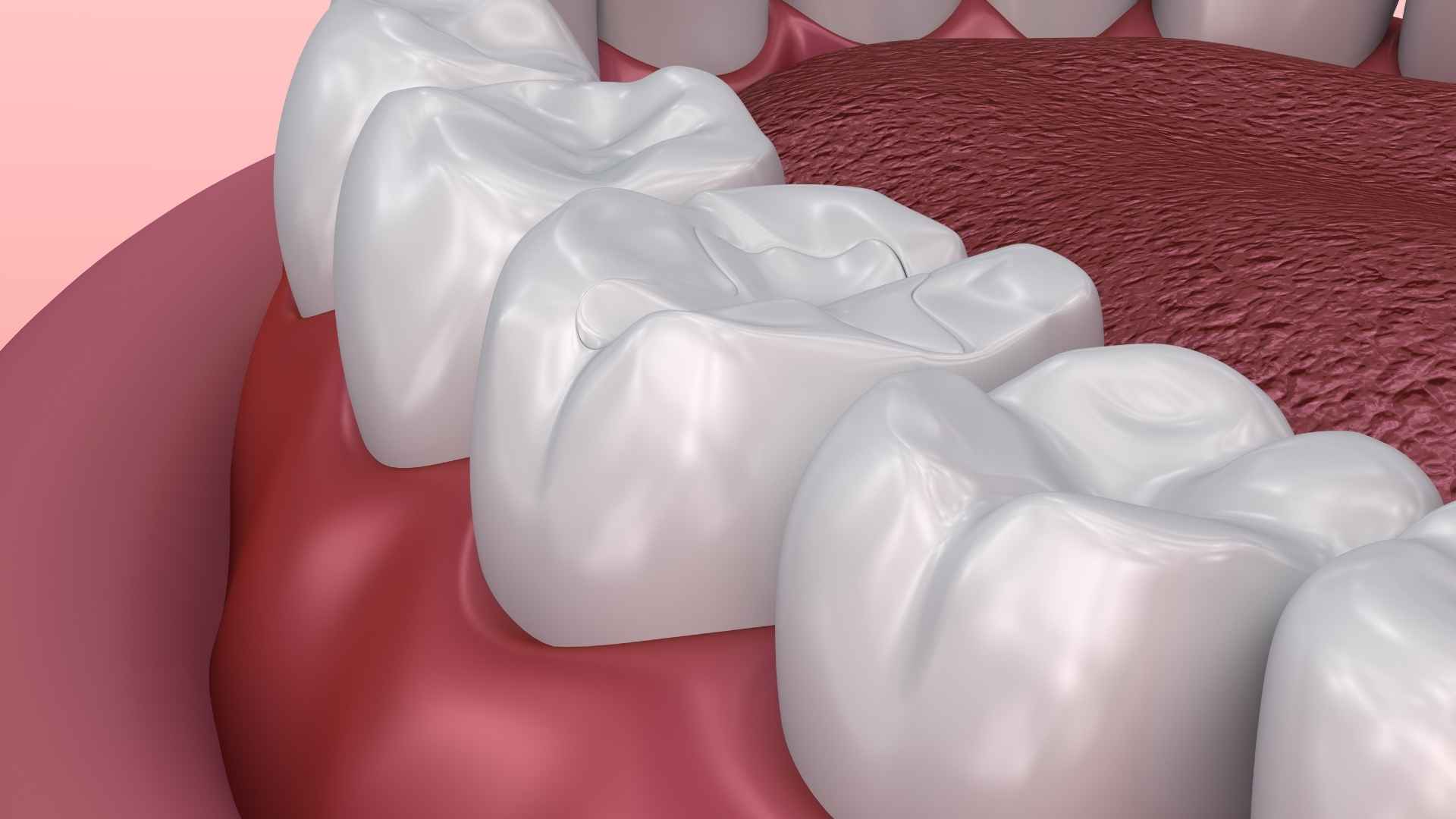 Pit & Fissure Sealants in Thane