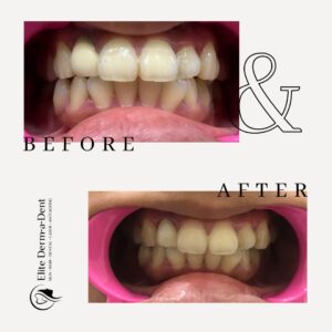 Dental Before and After 6