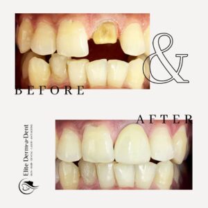 Dental Before and After 9