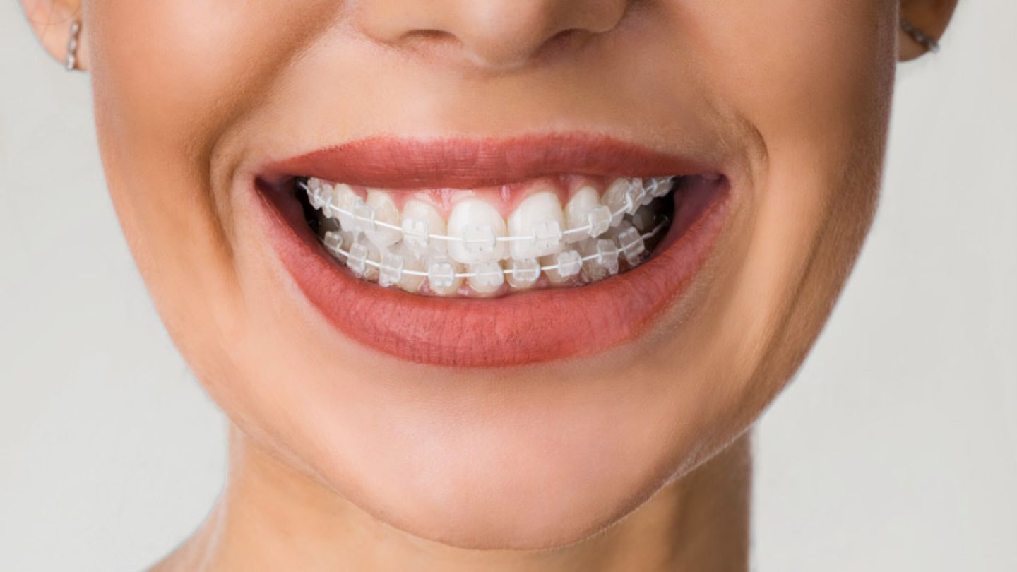 Ceramic Braces in Thane: Experience the Power of Discreet Orthodontics 1 Ceramic Braces in Thane