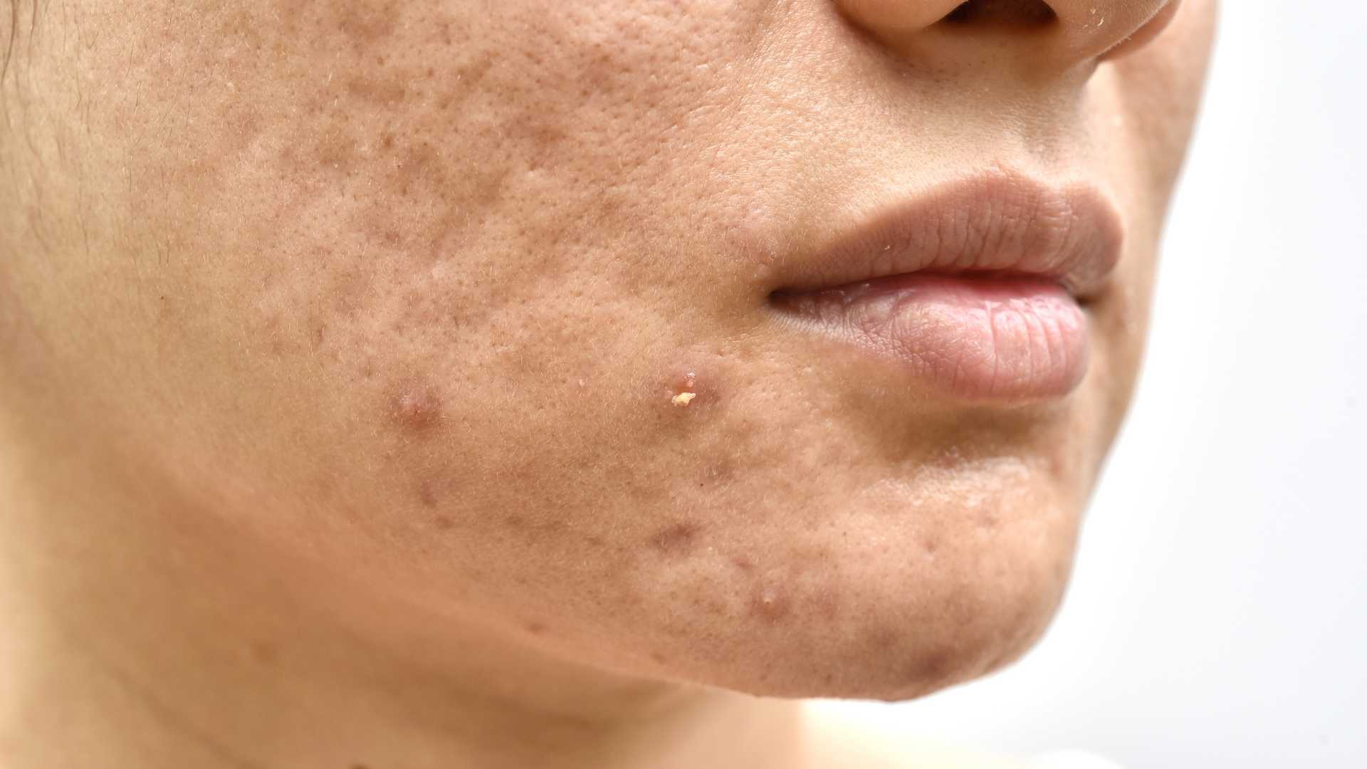 Acne Treatment