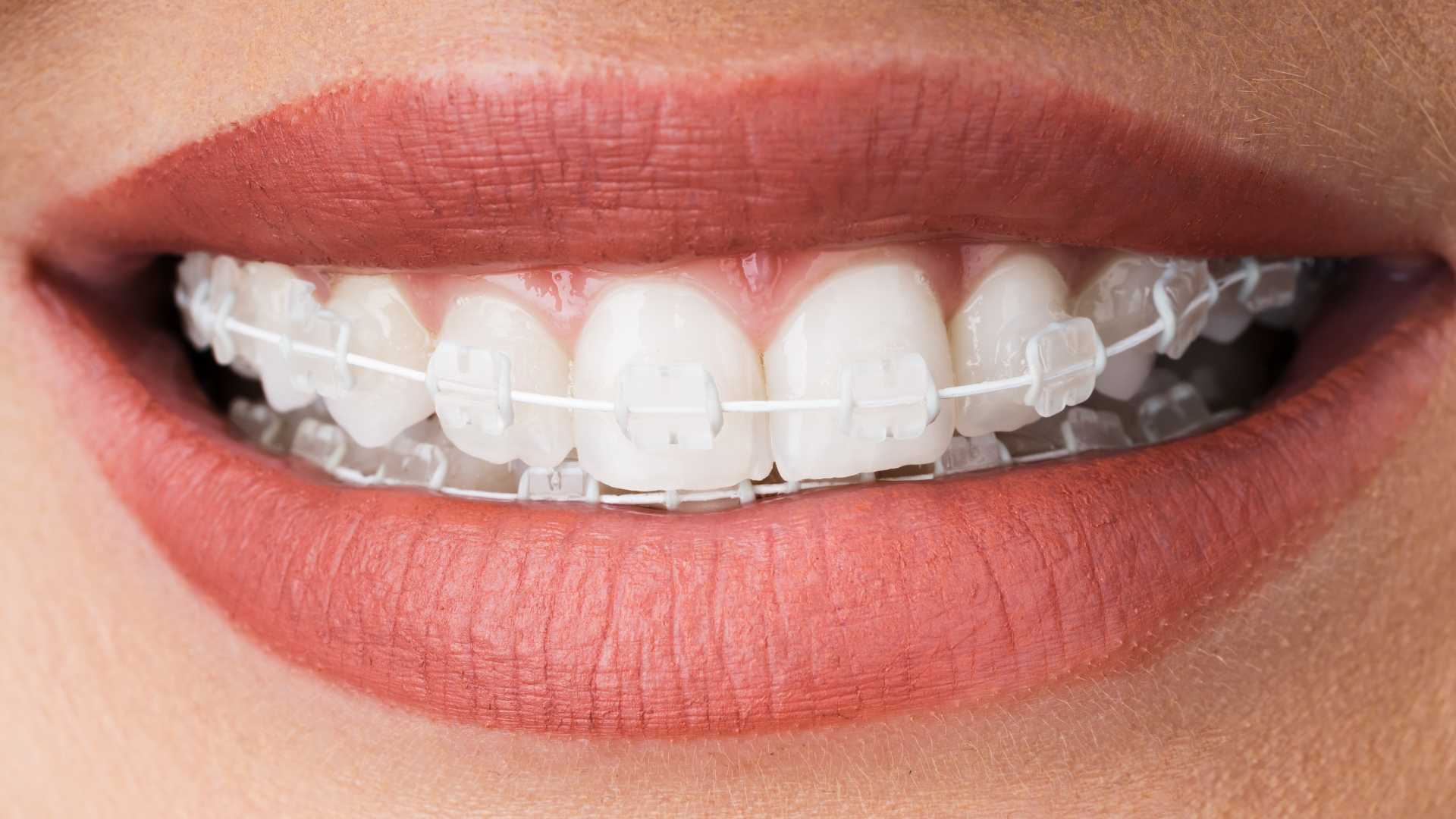 Ceramic Braces