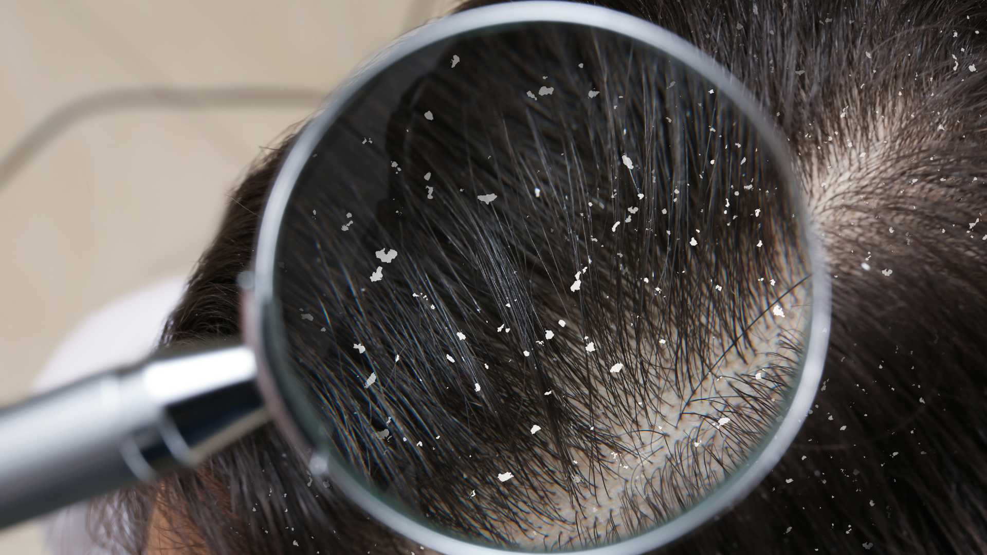 Dandruff Peel in Thane | Dr. Arefa Patel | Elite Dermadent 1 Dandruff Peel in Thane
