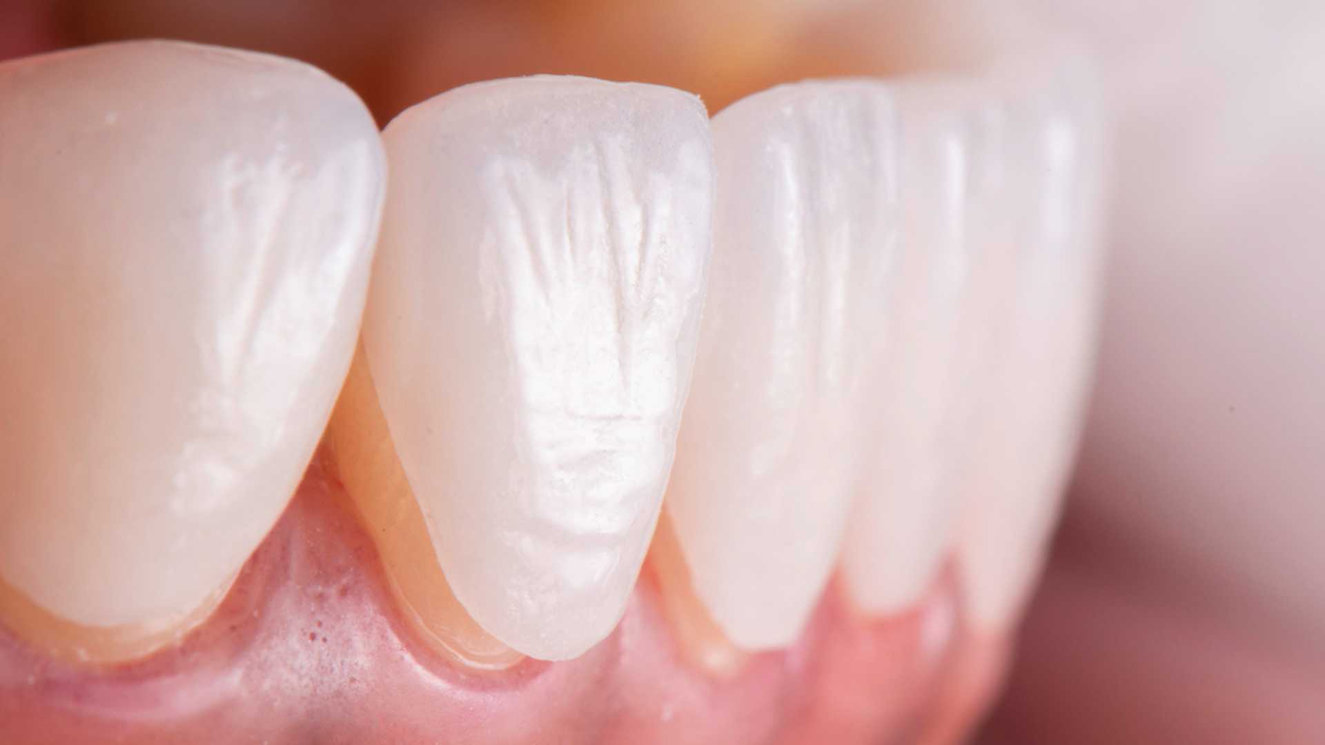 Dental Laminates