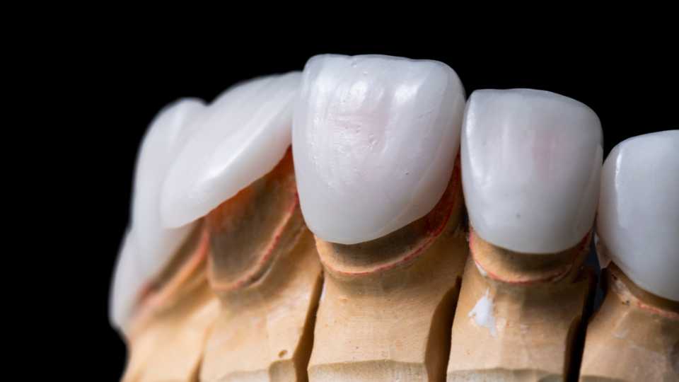 Dental Veneers in Thane | Dr. Saurabh Pakhale | Elite Dermadent 1 Dental Veneers in Thane