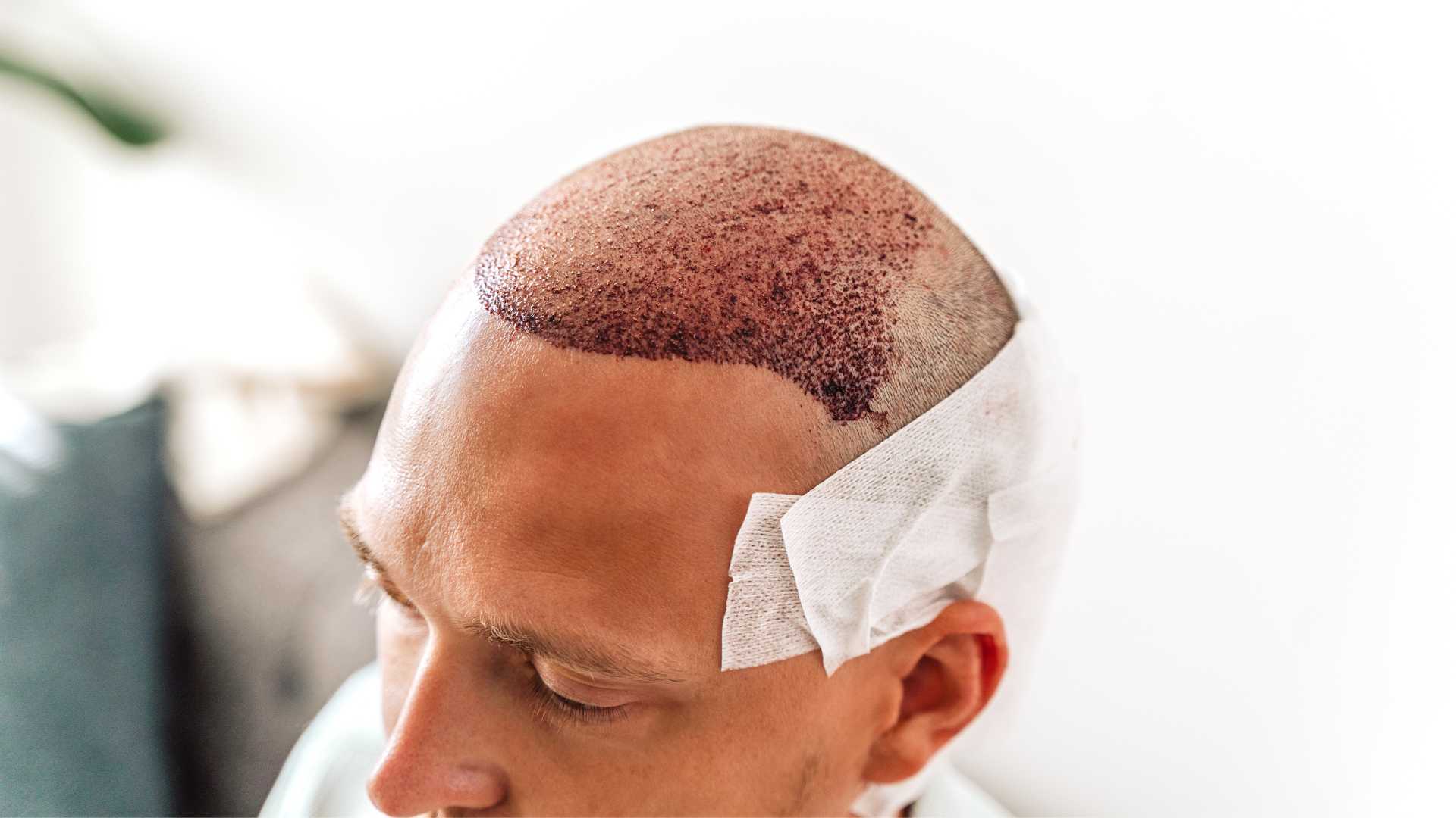 FUE Hair Transplant