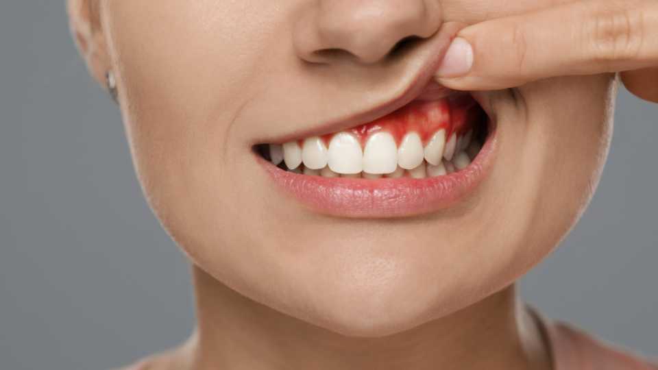 Gum Depigmentation in Thane | Dr. Arefa Patel | Elite Dermadent 1 Gum Depigmentation in Thane