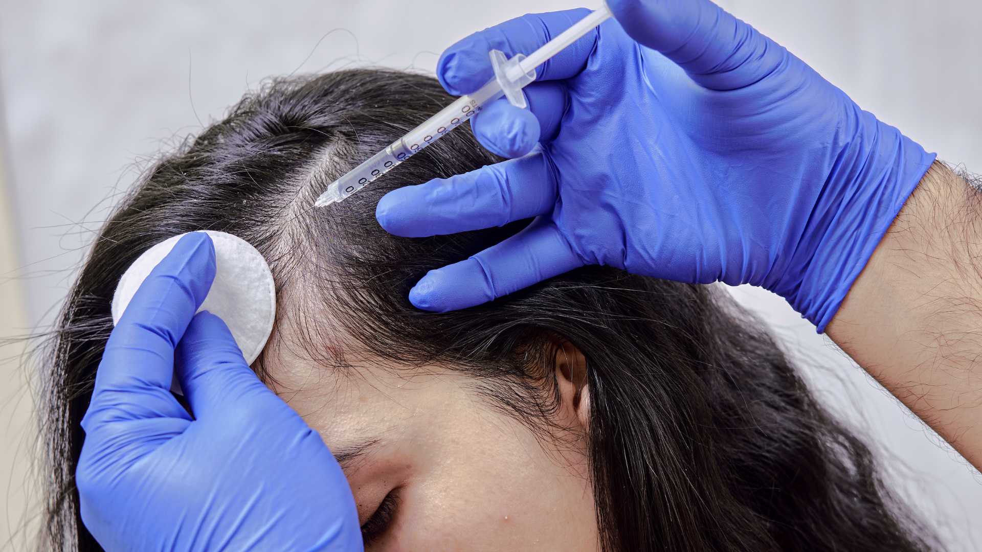 PRP Hair Treatment