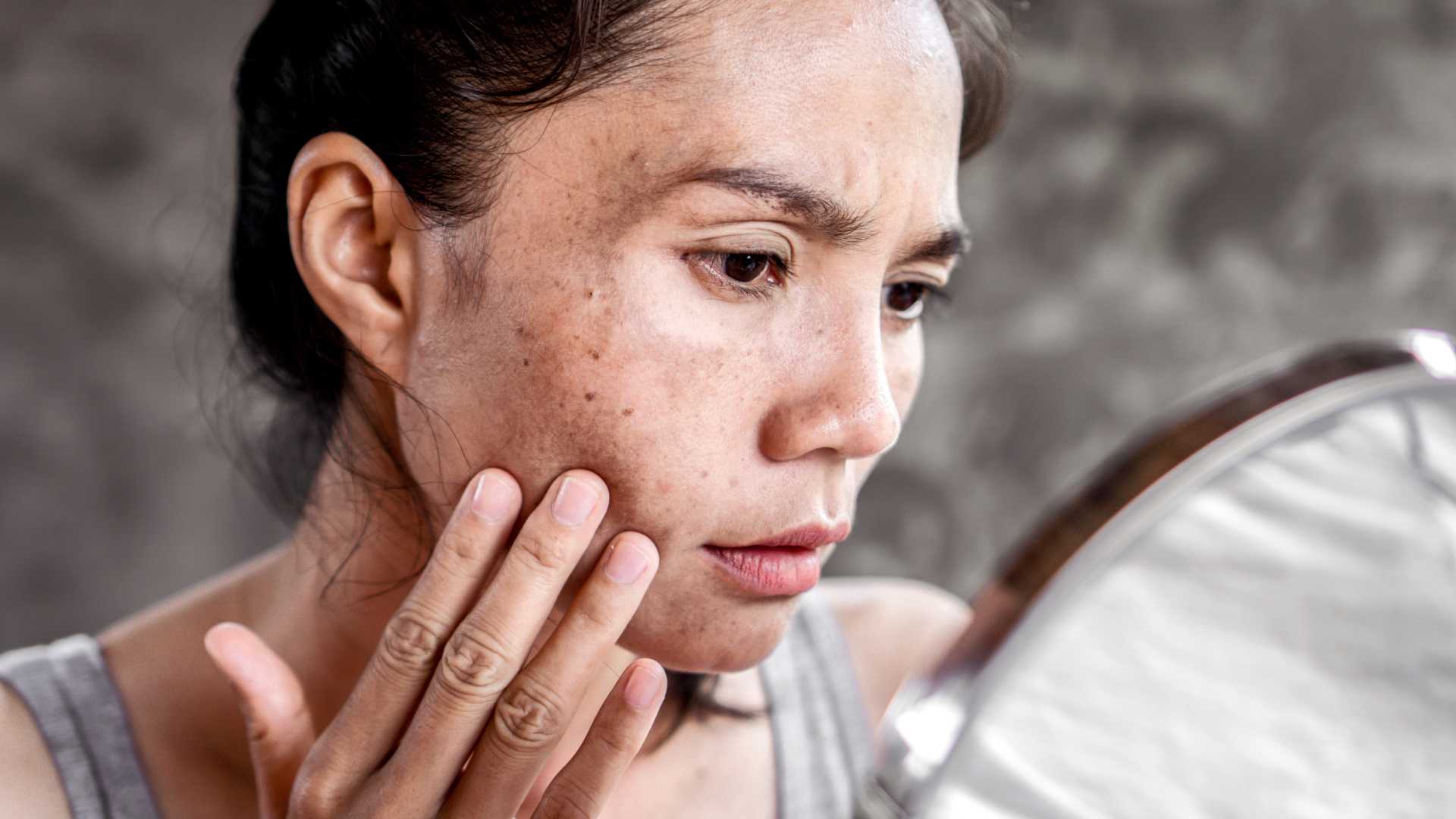 Pigmentation Treatment
