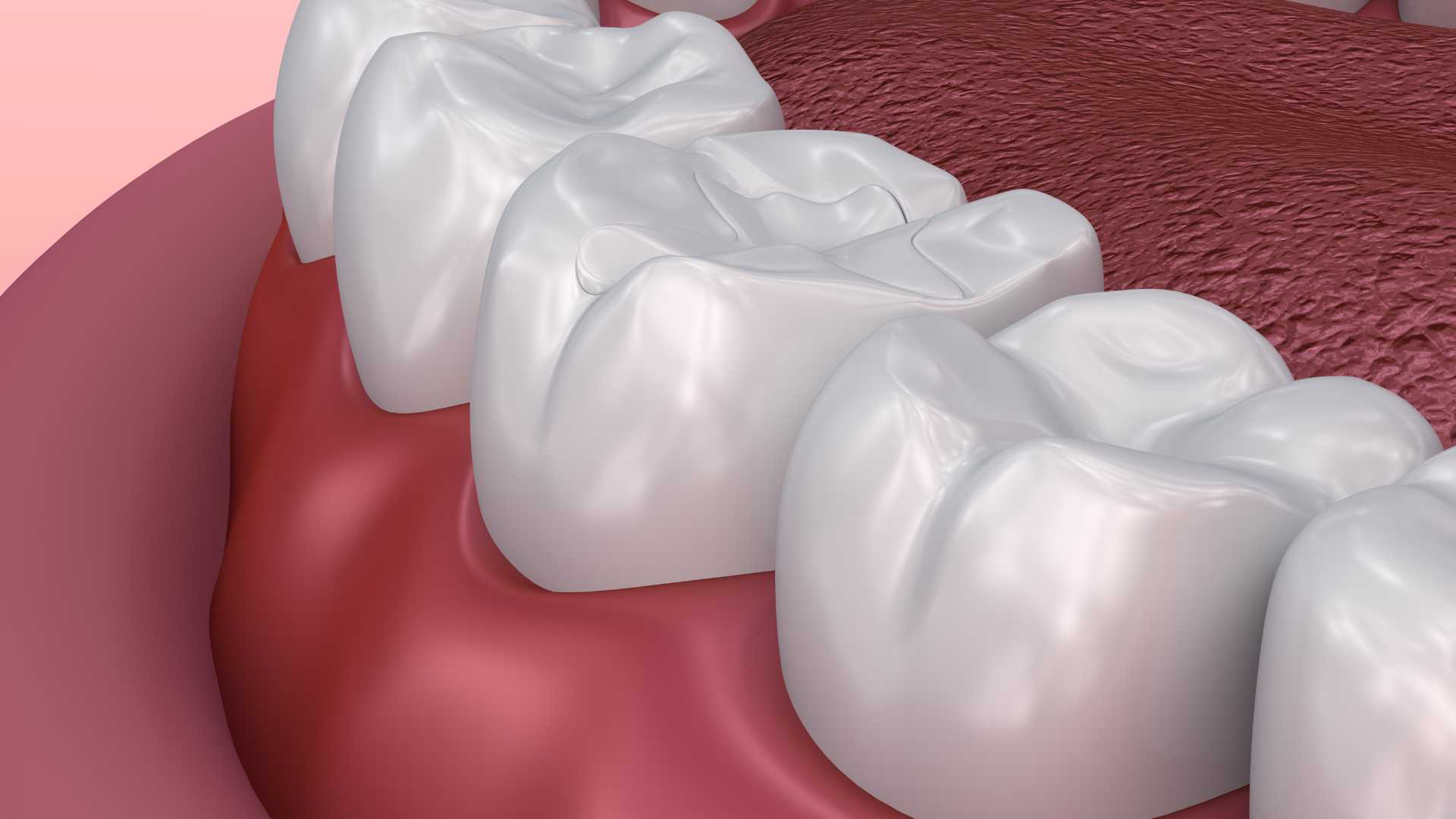 Pit and Fissure Sealants