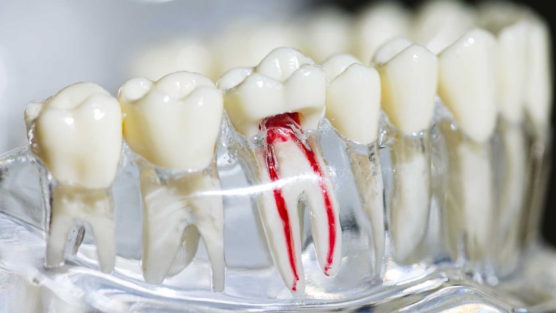 Root Canal Retreatment