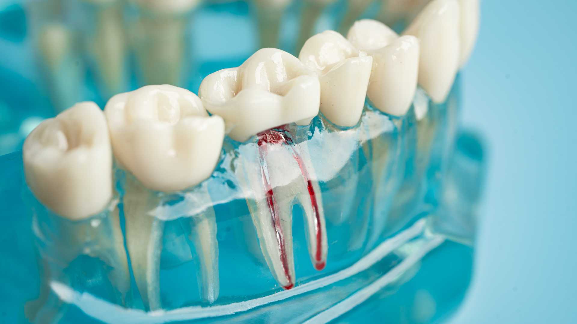 Root Canal Treatment