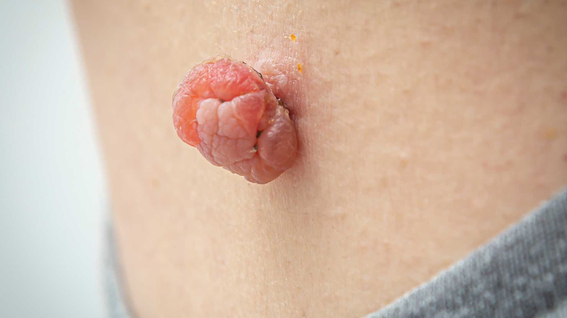 Skin Tag and DPN Removal