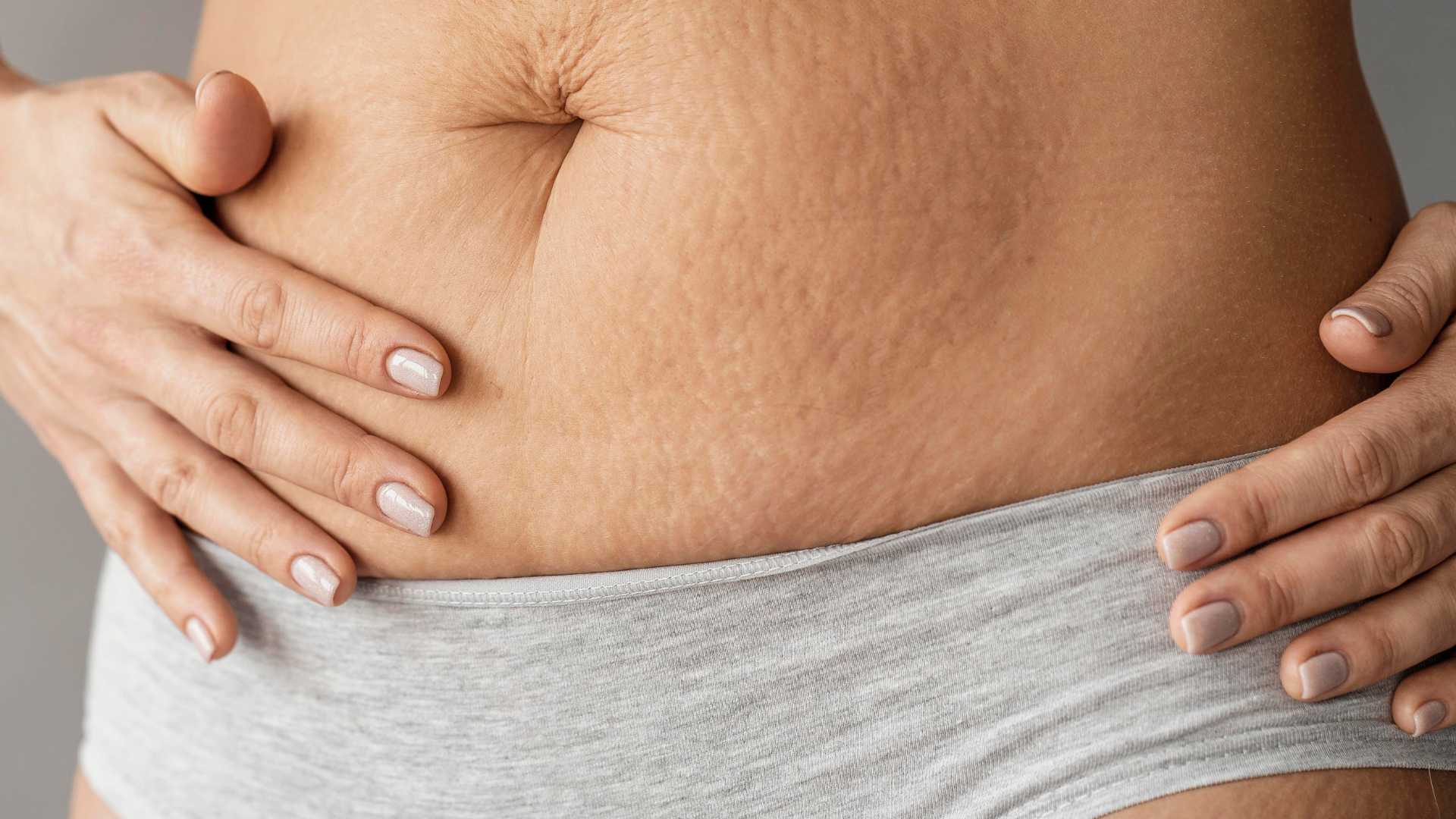Stretch Marks Treatment