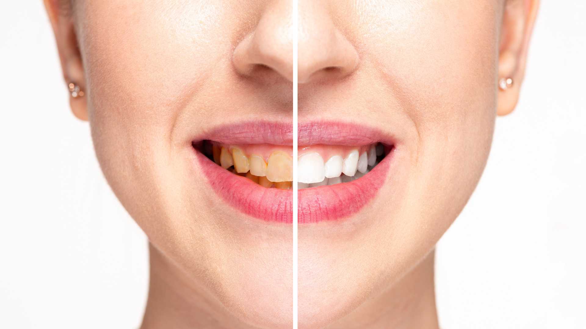 Teeth Cleaning and Polishing