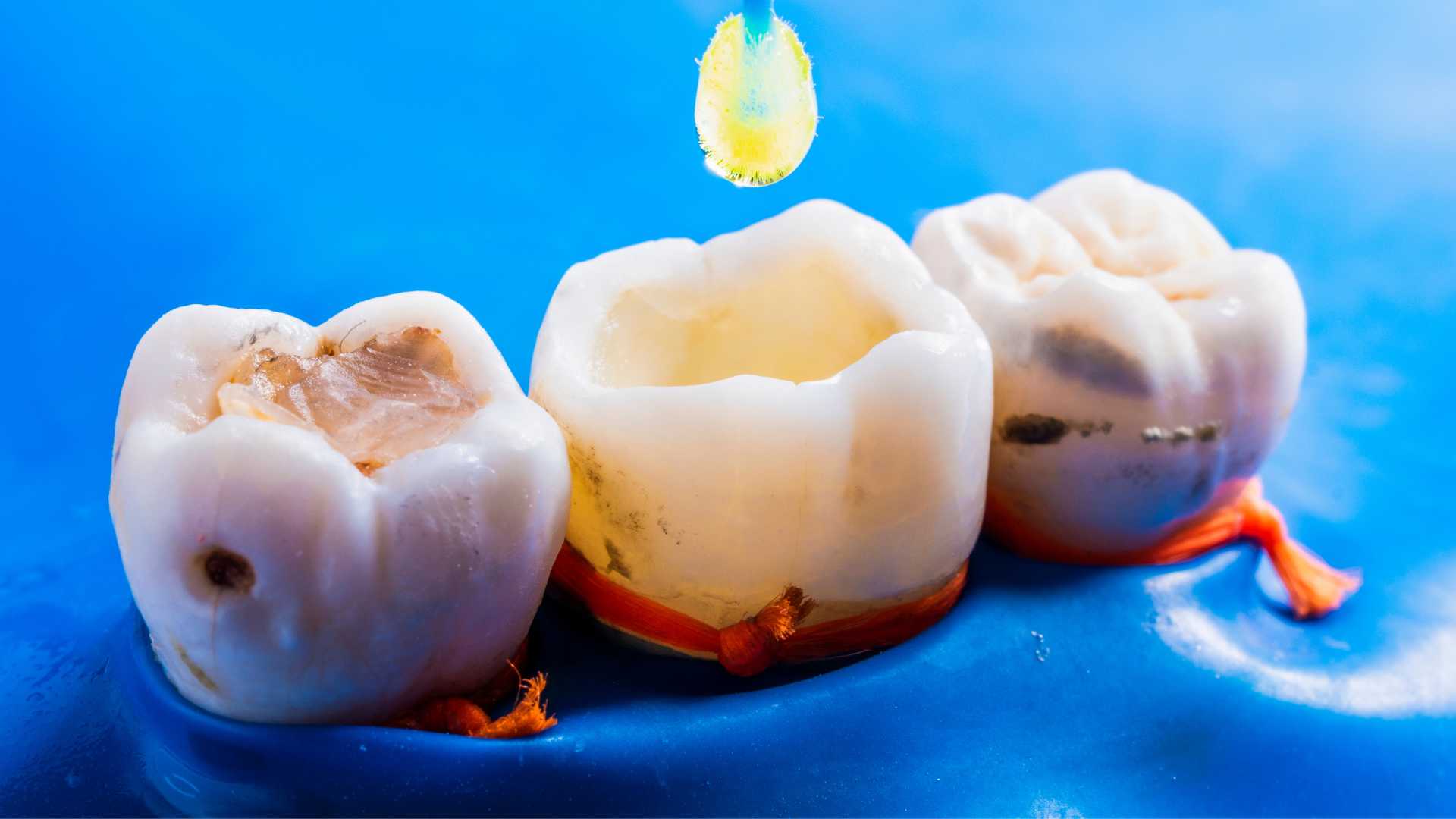 Tooth Filling