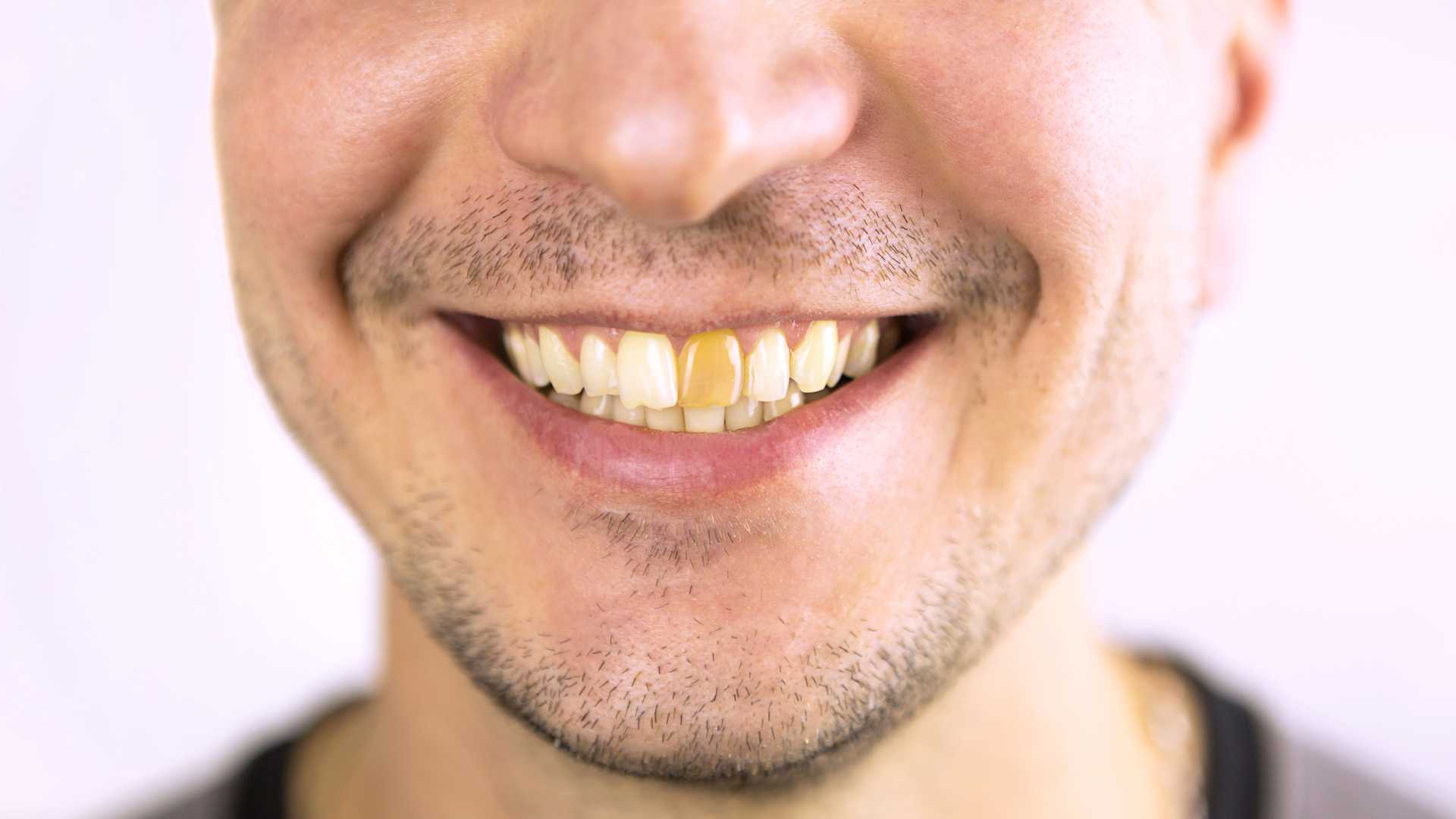 Tooth Restoration