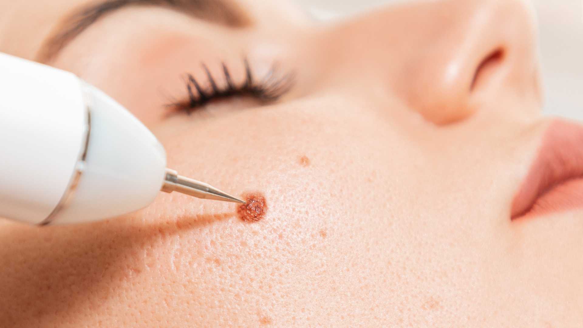 Wart Removal