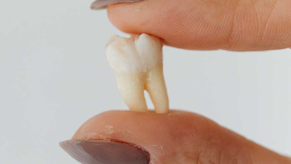 Wisdom Tooth Removal in Thane