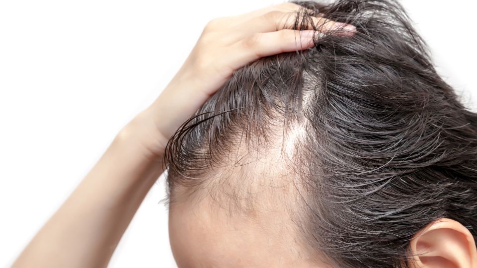 Alopecia Areata Treatment in Thane