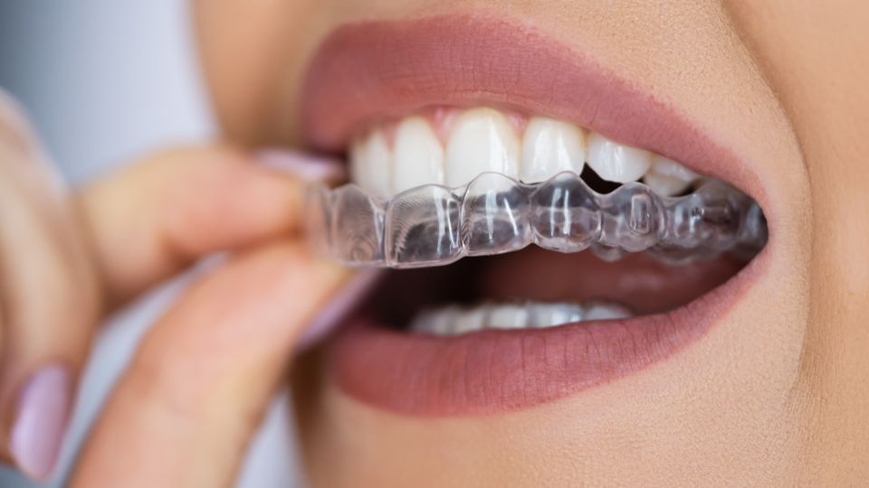 Clear Aligners in Thane | Dr Saurabh Pakhale | Elite Dermamdent 1 Clear Aligners in Thane at Elite Dermadent