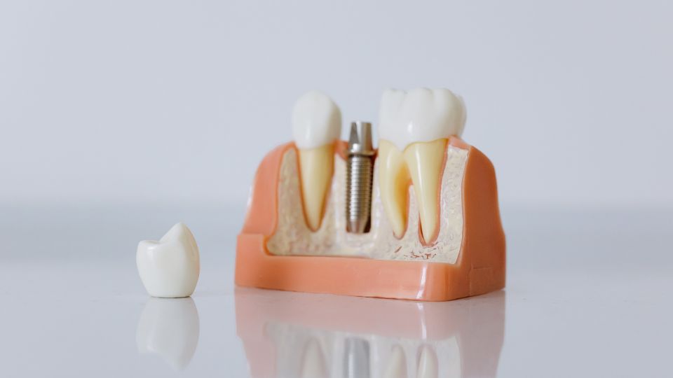 Dental Bridges in Thane