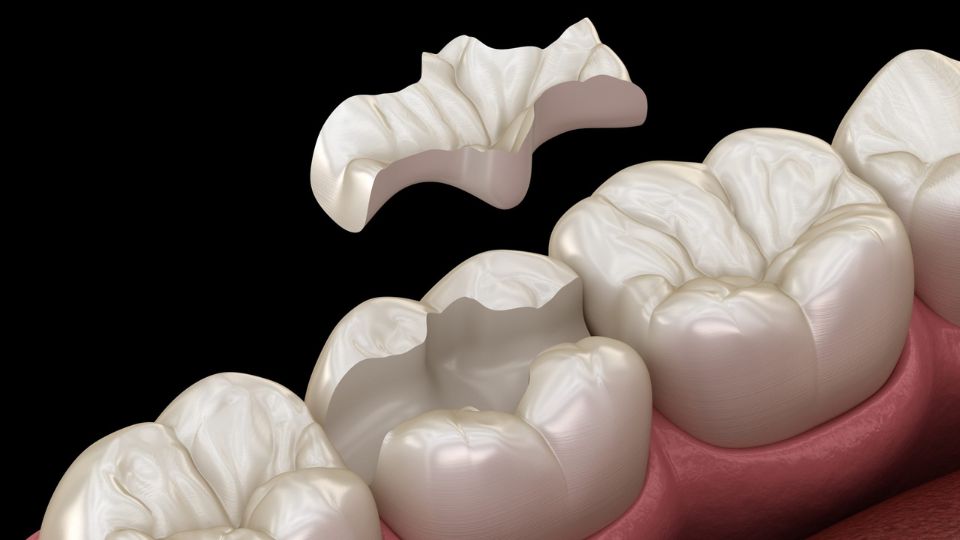 Dental Inlays in Thane | Dr. Saurabh Pakhale | Elite Dermadent 1 Dental Inlays in Thane